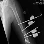 left Humerus 1-17-07-0002