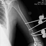 left Humerus 1-17-07-0003