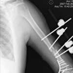 left Humerus 2-26-07-0002