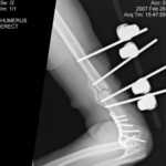 left Humerus 2-26-07-0003