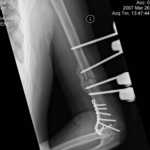 left Humerus 3-26-07-0002