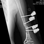 left Humerus 3-26-07-0003