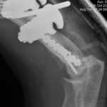 left elbow 10-23-06-0002