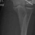 left elbow 10-23-06-0003