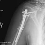 right Humerus 3-26-07-0002